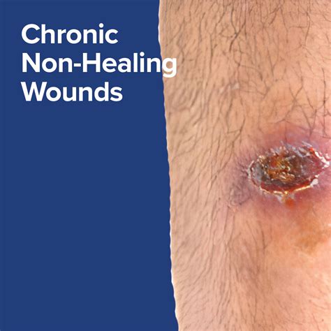 CHRISTUS Wound Care Westover Hills San Antonio | WoundCentrics, LLC
