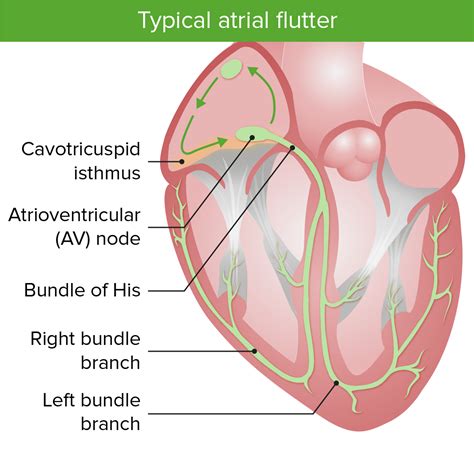 Image result for Counterclockwise Atrial Flutter