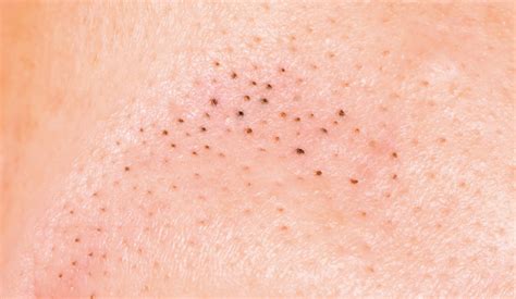 What Are Black Heads