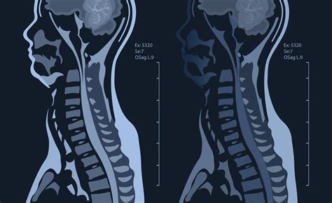 MRI of the cervical spine with and without contrast, MRI with bilateral ...