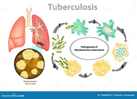 Stages Of Tuberculosis