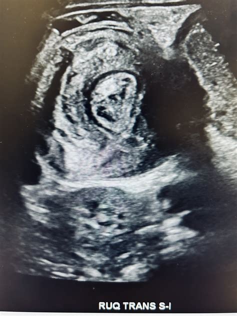 Image result for Alien Belly Noises