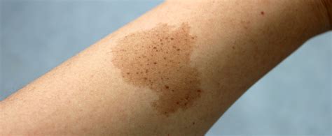 Birthmarks | Devonshire Dermatology | London