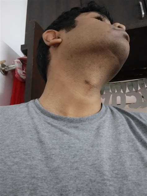 How to heal acne scars??? : r/malegrooming