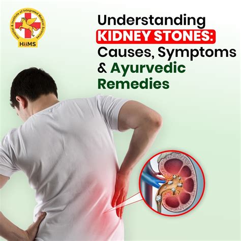 Kidney Stones Pain Location Women