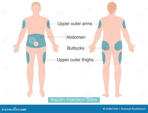 Sites For Injecting Insulin