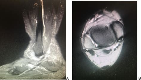 Peroneus quartus, an alternative for the repair of peroneus brevis tendon tear - Foot & Ankle ...