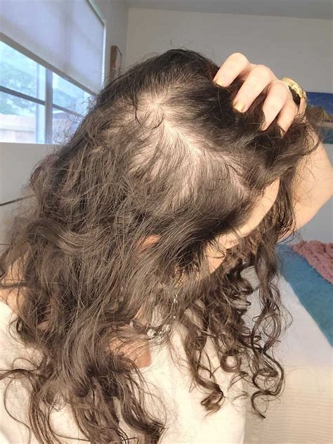 Normal Hair Density 的图像结果