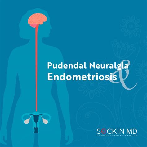Pudendal Neuralgia and Endometriosis