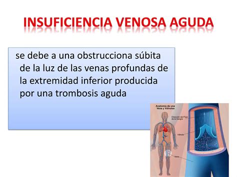 Insuficiencia venosa | PPTX