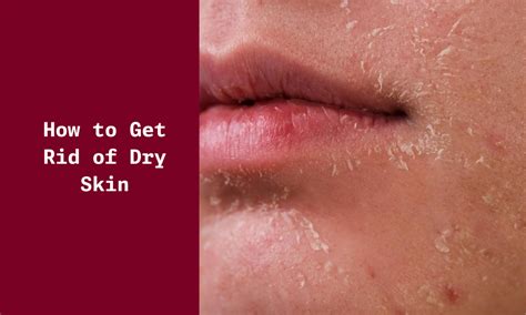 How to Get Rid of Dry Skin - What Can Help to Prevent Dry Skin - Ningen ...