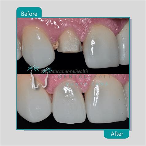 Types of Dental Crown Materials