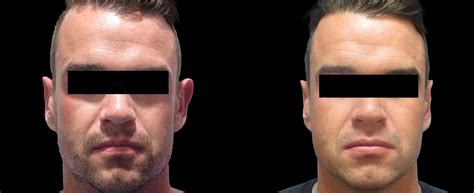 Image result for Ear Modification