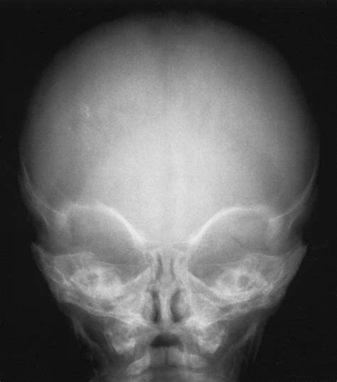 The Infant Skull: A Vault of Information | RadioGraphics