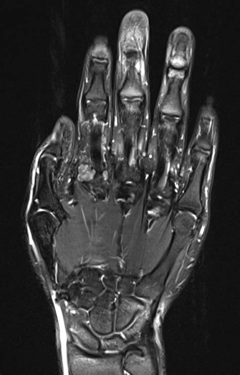 Image result for Soft Tissue Sarcoma Hand