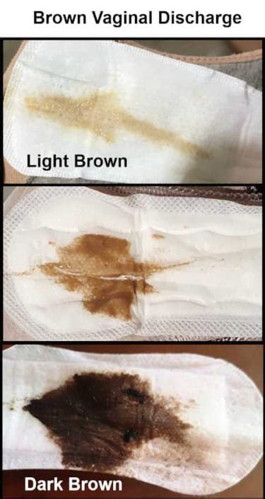 Brown Vaginal Discharge: Causes, Treatment, and When to get Tested ...