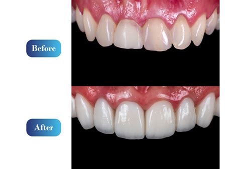 Everything You Need to Know About Front Tooth Crown