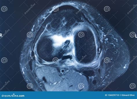Knee injury mri mcl tear stock photo. Image of medicine - 156029710