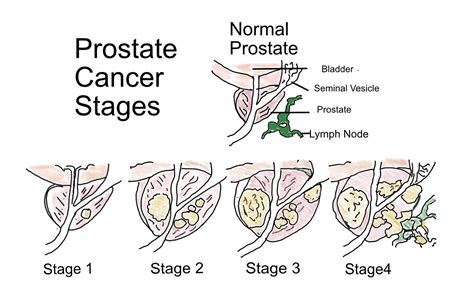 Prostate Cancer 的图像结果