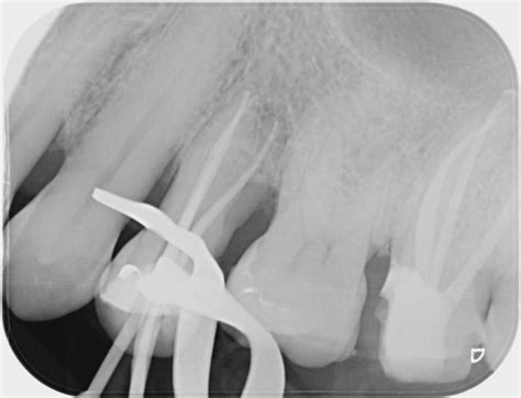Root Canal Procedure Molar at Sean Chaffey blog