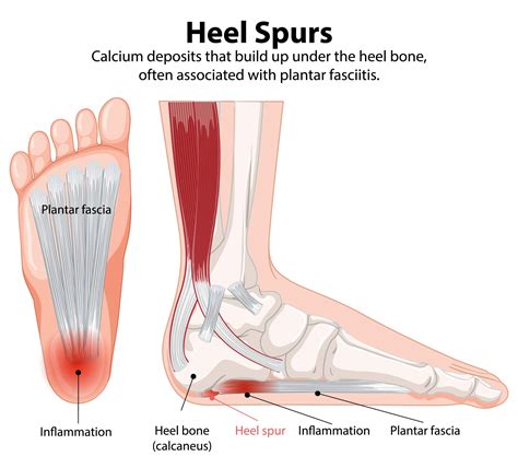 Heel Spur