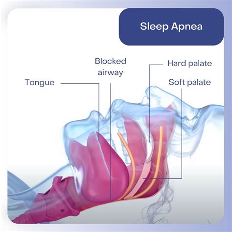 Image result for Sleep Apnea Example