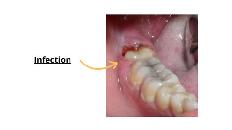 Swollen Gums from Wisdom Teeth: What’s Normal and When to Worry