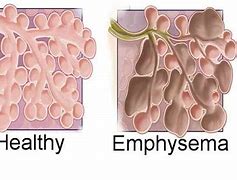 Image result for Emphysema