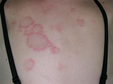 subacute cutaneous lupus