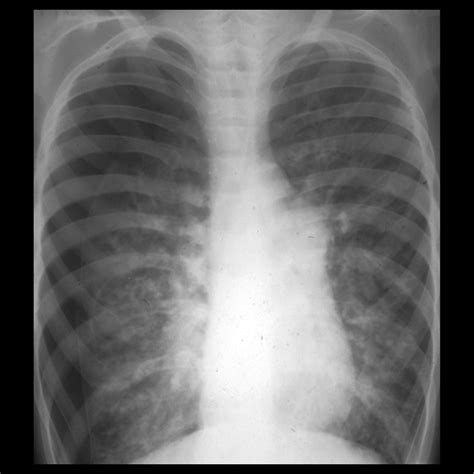 Pediatric Pneumothorax | Pediatric Radiology Reference Article ...