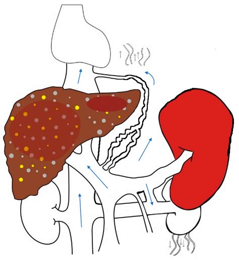 Portal Hemodynamics after Living-Donor Liver Transplantation ...