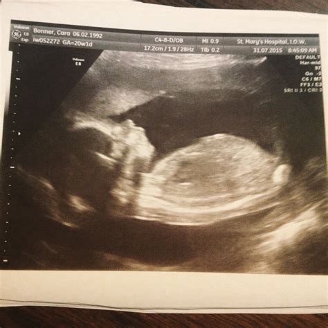 20 week/Anatomy Scan Ultrasound Thread - Page 3 — The Bump