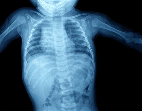 What Does A Normal Abdominal X Ray Look Like at Philip Pacheco blog