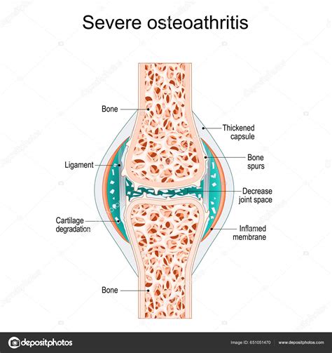 Severe Osteoarthritis Synovial Joint Bone Spurs Inflamed Membrane Decreased Joint Stock ...