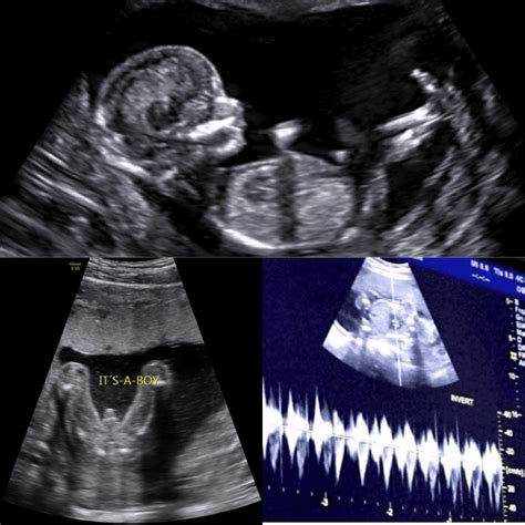 Anatomy Scan | Detailed 20-Week Ultrasound for Baby's Health