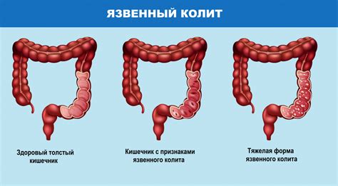 НЯК (неспецифический язвенный колит): причины возникновения, признаки ...
