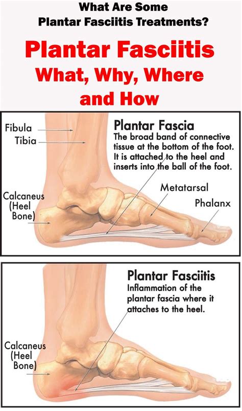 Plantar Fasciitis 的图像结果