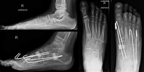 Kindliche Fußkorrekturen mit kommerziellem Allograft - Orthopädie ...