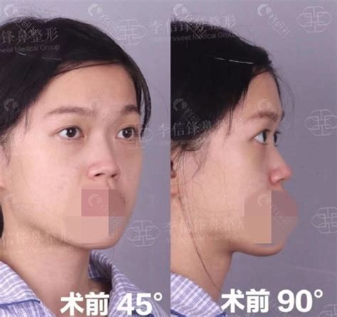 向宏伟和陈桂飞哪个医生好做鼻子技术更好？ - 美妆技巧 - 整形医院排行榜
