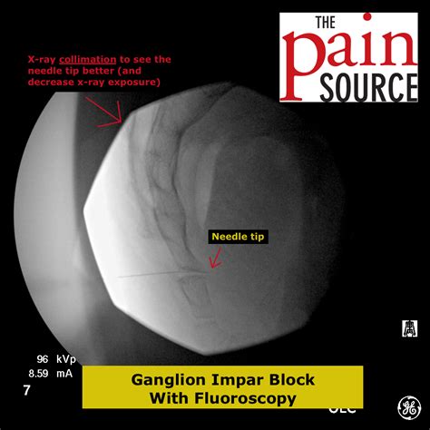 Ganglion Impar Block with Fluoroscopy - The Pain Source - Makes ...