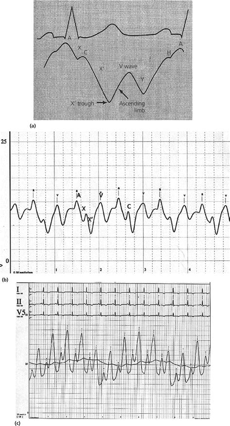 5: The atrial waveform | Thoracic Key