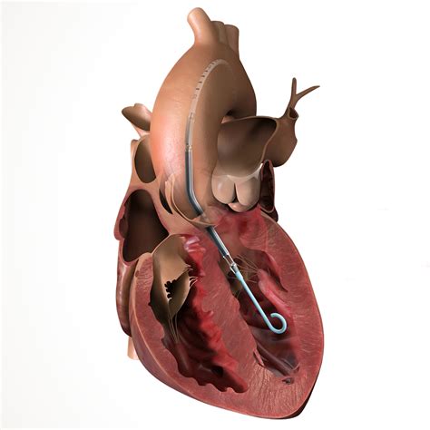 Impella Heart at Kristy Mulkey blog