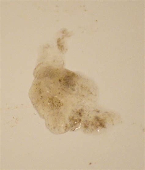 “Brown Specks in Mucus” Poll: Thread - Mystery Condition in Current ...