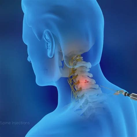 Cervical Injections