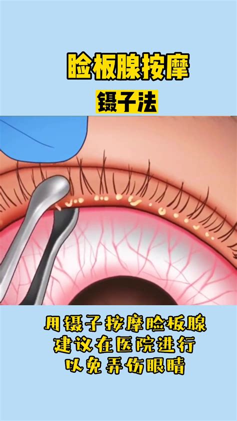 眼科医生邓世靖 睑板腺按摩 睑板腺按摩动画演示-度小视