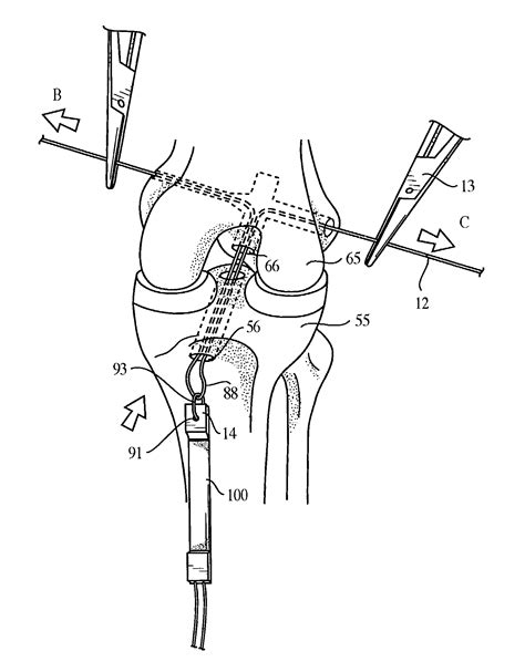 Image result for Transnasal Loop Fixation