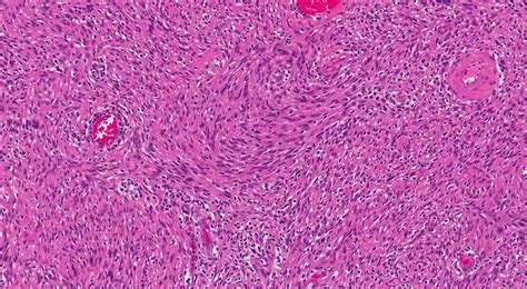 What is a spindle cell neoplasm? | MyPathologyReport