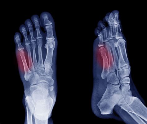 Fifth Metatarsal or Jones Fracture