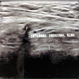 Image result for Transillumination Test Testis