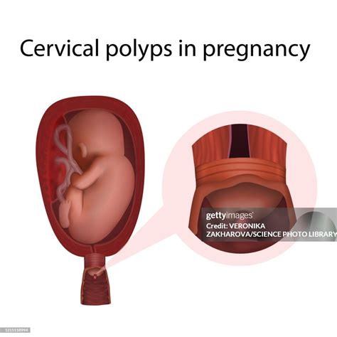 Cervical Polyps